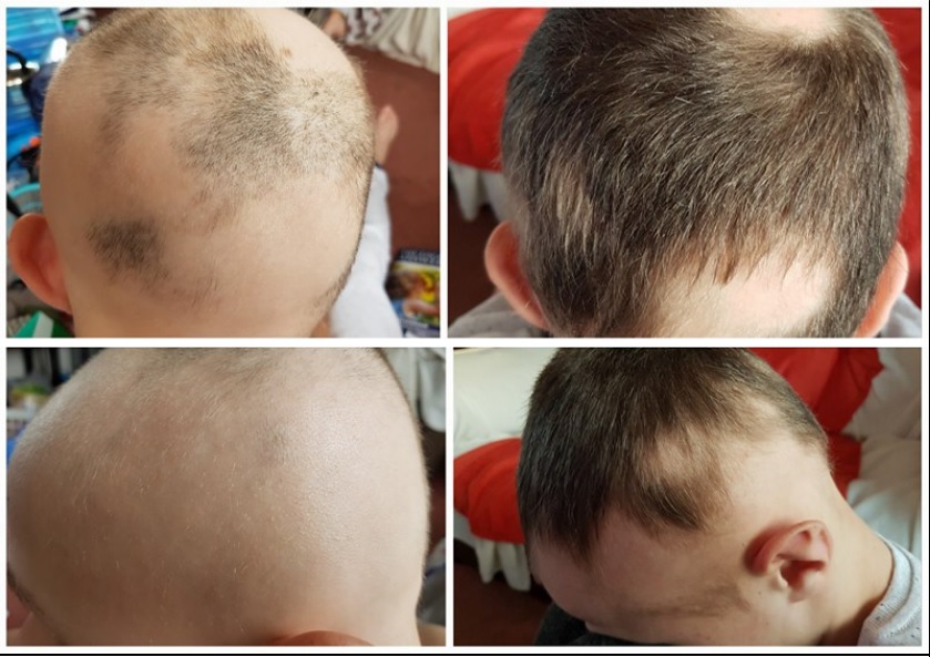 Alopecia healing